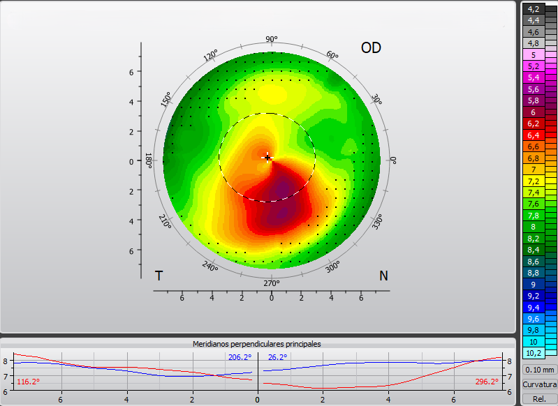 Topografía queratocono
