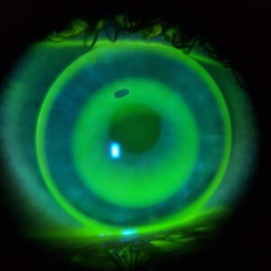 Funcionalidad lentes Orto-K